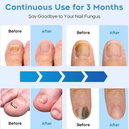 Nail Fungus Laser Device Cure Onychomycosis Toenail Fingernail