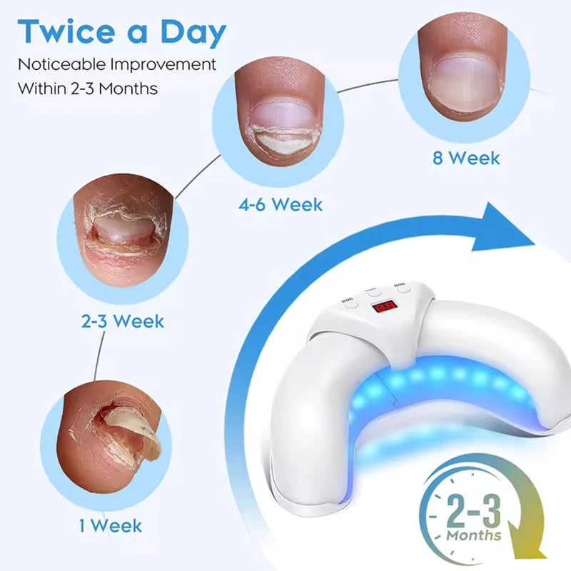 Nail Fungus Laser Device Cure Onychomycosis Toenail Fingernail
