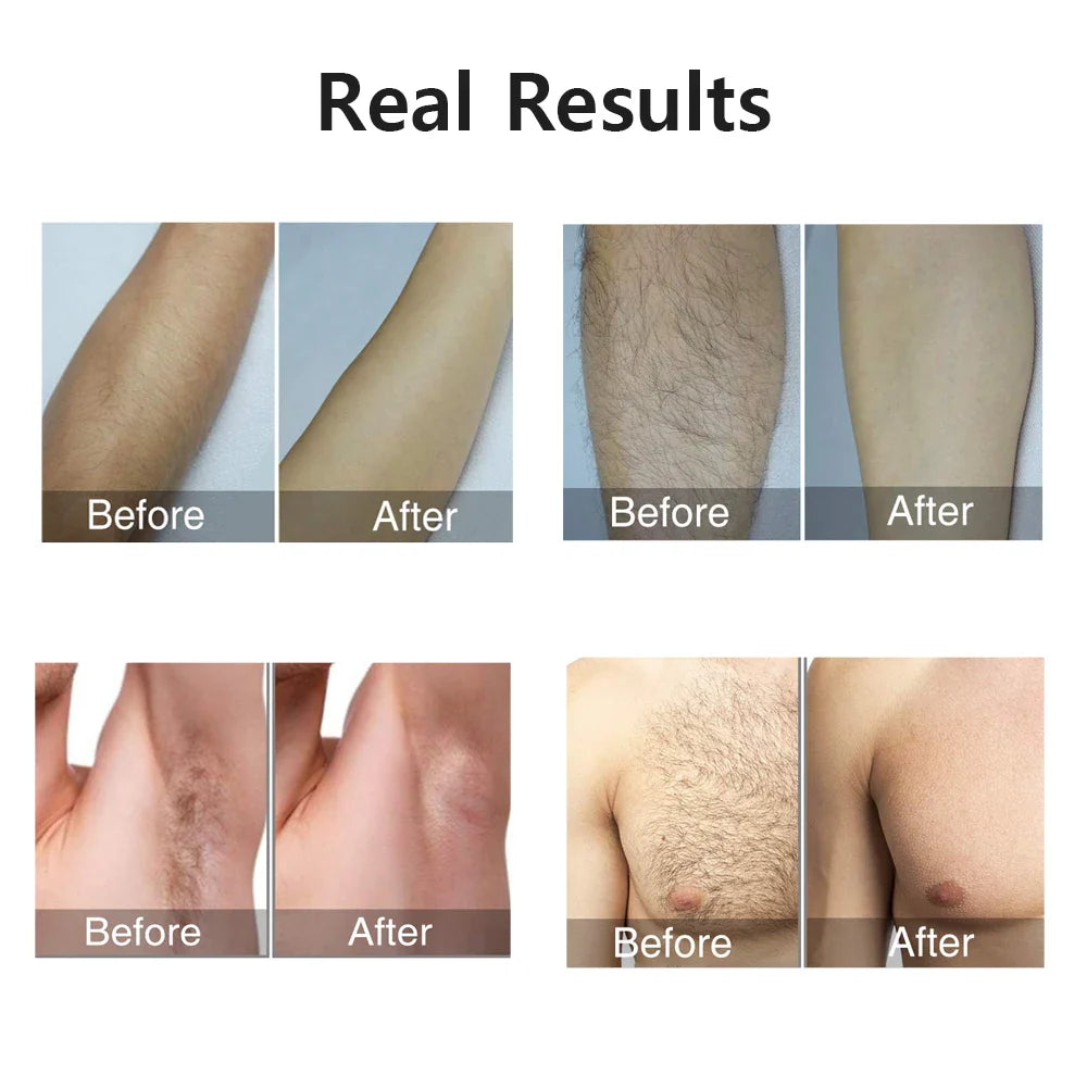Wireless Portable Remover Laser Epilator - WiseWell.Shop