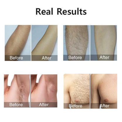 Wireless Portable Remover Laser Epilator - WiseWell.Shop